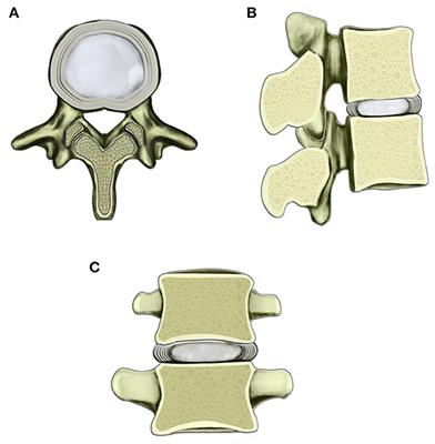 Emerging Issues Questioning the Current Treatment Strategies for Lumbar Disc Herniation